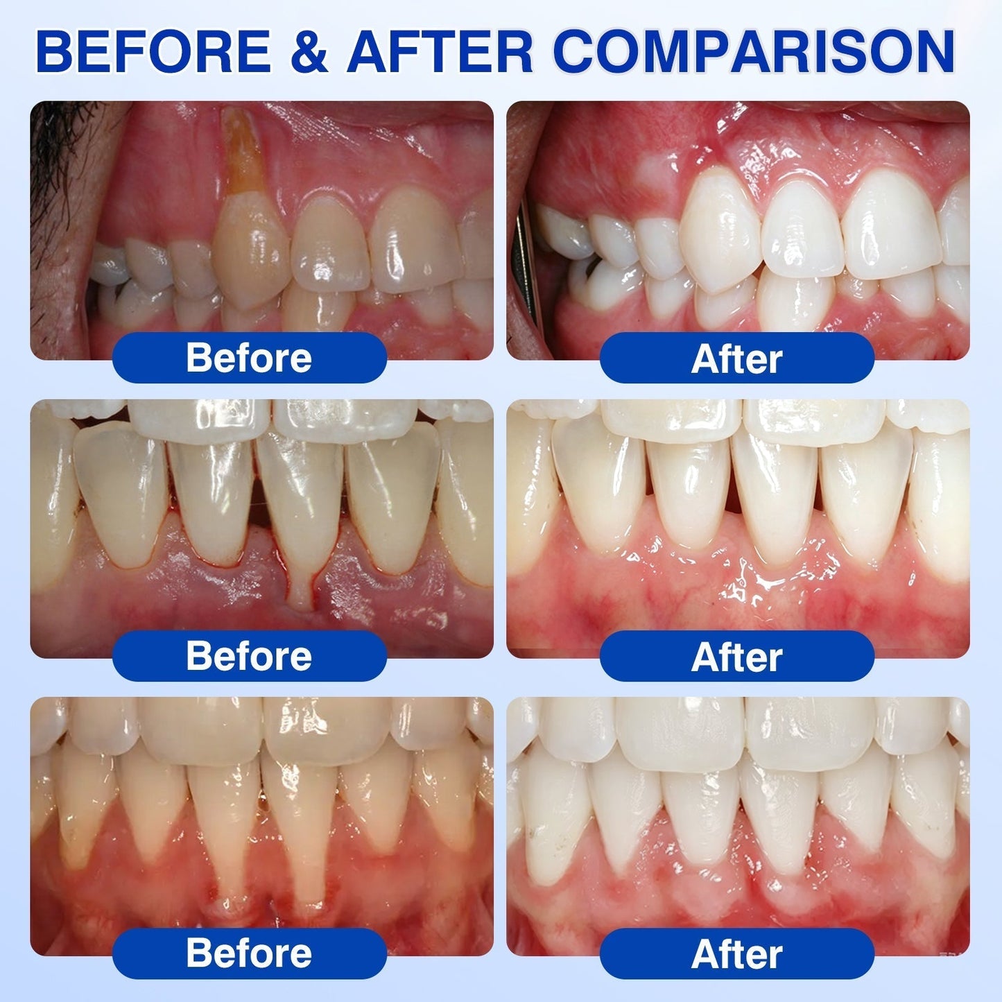 👨‍⚕️🦷🛡️Tiworld ® Gum health Periodontal Repair Gel