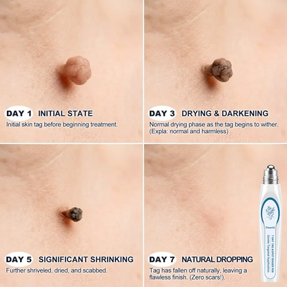 FDA Registered Facility | Tiworld® 7-Day Skin Tag & Spot Eraser Painless & Scar-Free Advanced Imperfection Removal Rollerball Pen